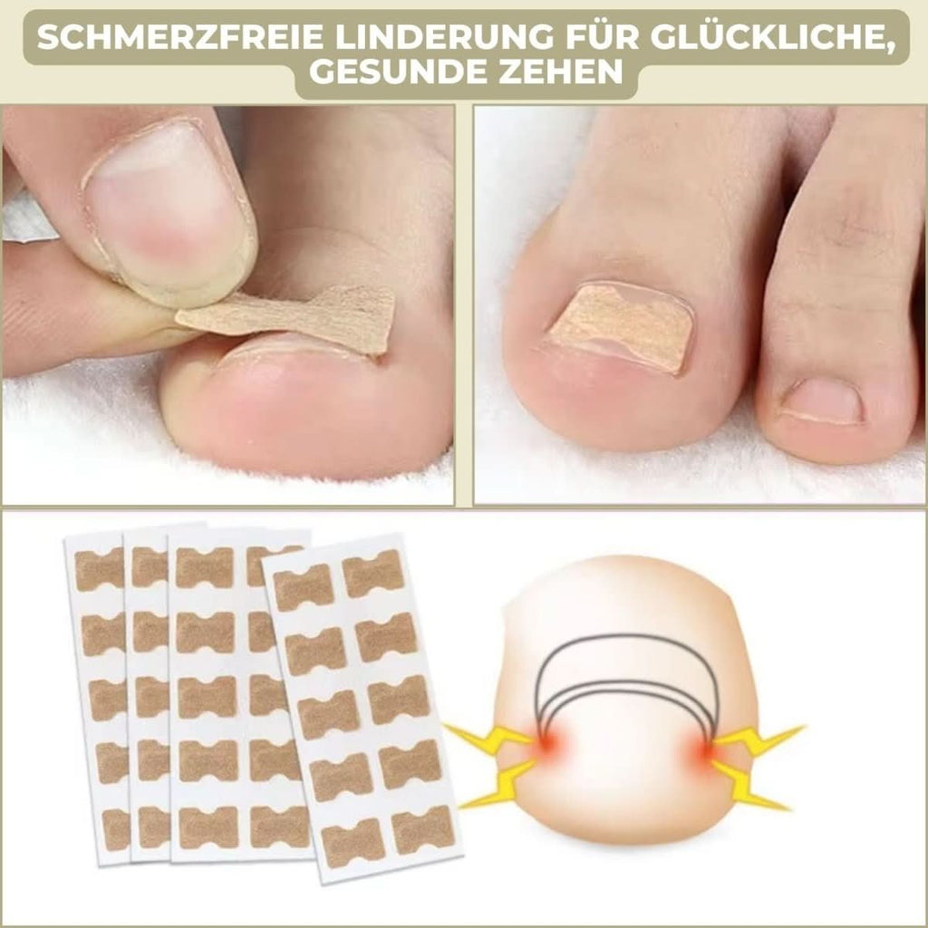 Gentle nail correction against ingrown nails & pain