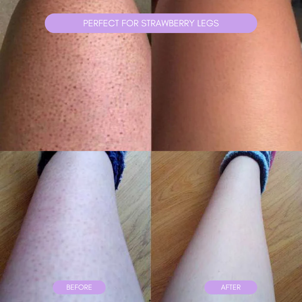 Hair removal device for smooth soft skin