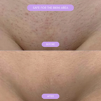 Hair removal device for smooth soft skin