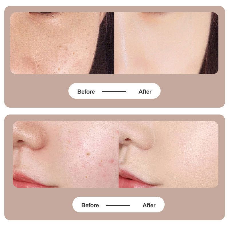 Plasma Pen Laser for Tattoo and Mole Removal
