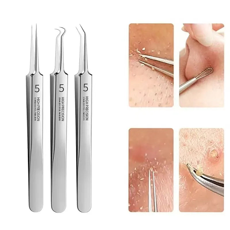 Tweezer for Removing Blackheads on the Face