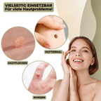 DermaLinx Wart Remover | Pain-Free Removal of Warts & Moles | For Home | Without Surgery