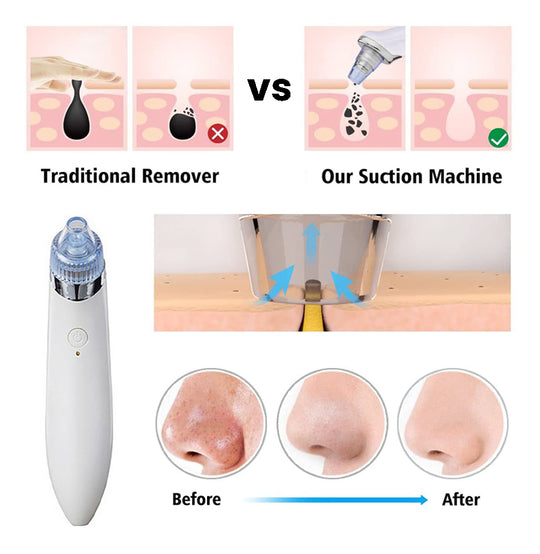 LuxeGlow Elite Blackhead Remover | Rechargeable 4-in-1 solution for a clear, radiant skin