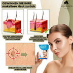 DermaLinx Wart Remover | Pain-Free Removal of Warts & Moles | For Home | Without Surgery