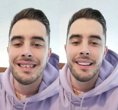 On Smile Veneers (Upper and Lower Jaw included)