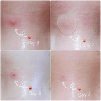 Skin Tag and Acne Patch