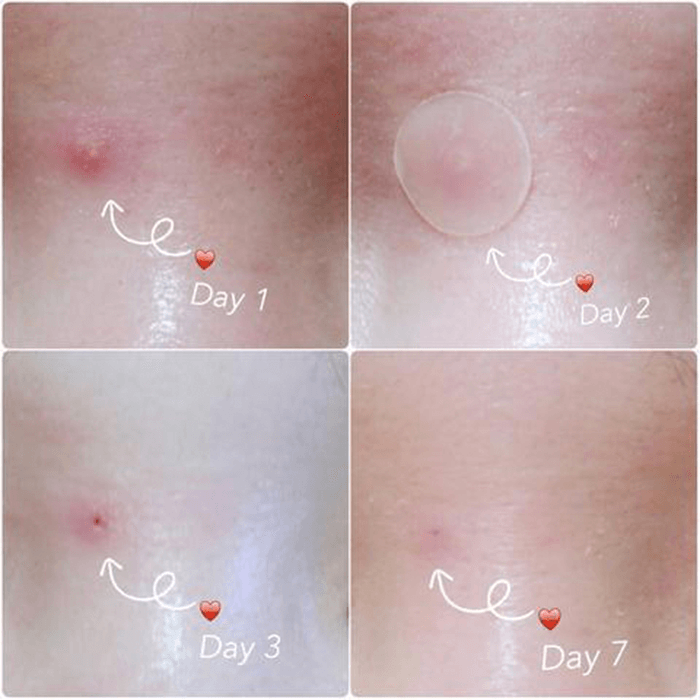 Skin Tag and Acne Patch