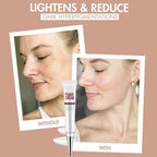 Face Freckles Removal Cream