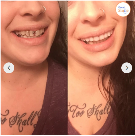 Snap-in Dental Prosthesis | 1+1 FREE!