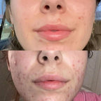 LumiGlow - Pain-Free Treatment: Non-Invasive Therapy