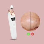 Nano Electrical Vacuum Blackhead Remover — Unleash your radiant clear skin without pain or stress