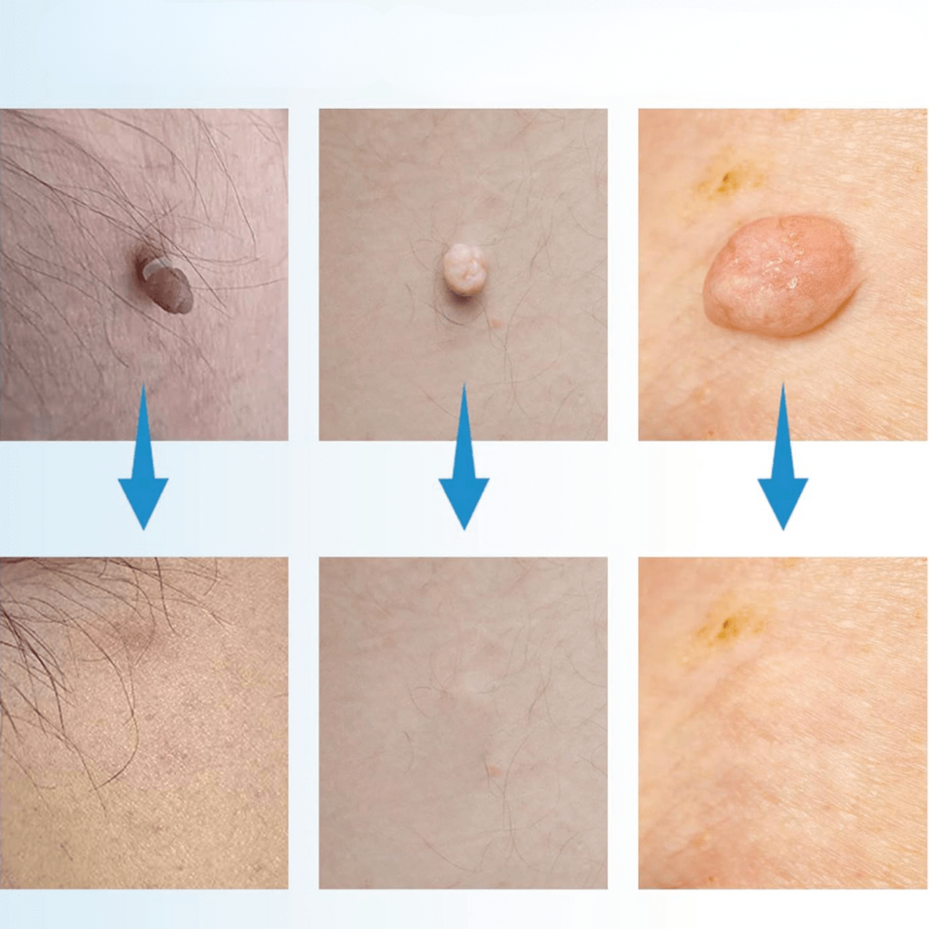 WartAway – Remove warts, completely without chemicals!
