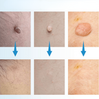 WartAway – Remove warts, completely without chemicals!
