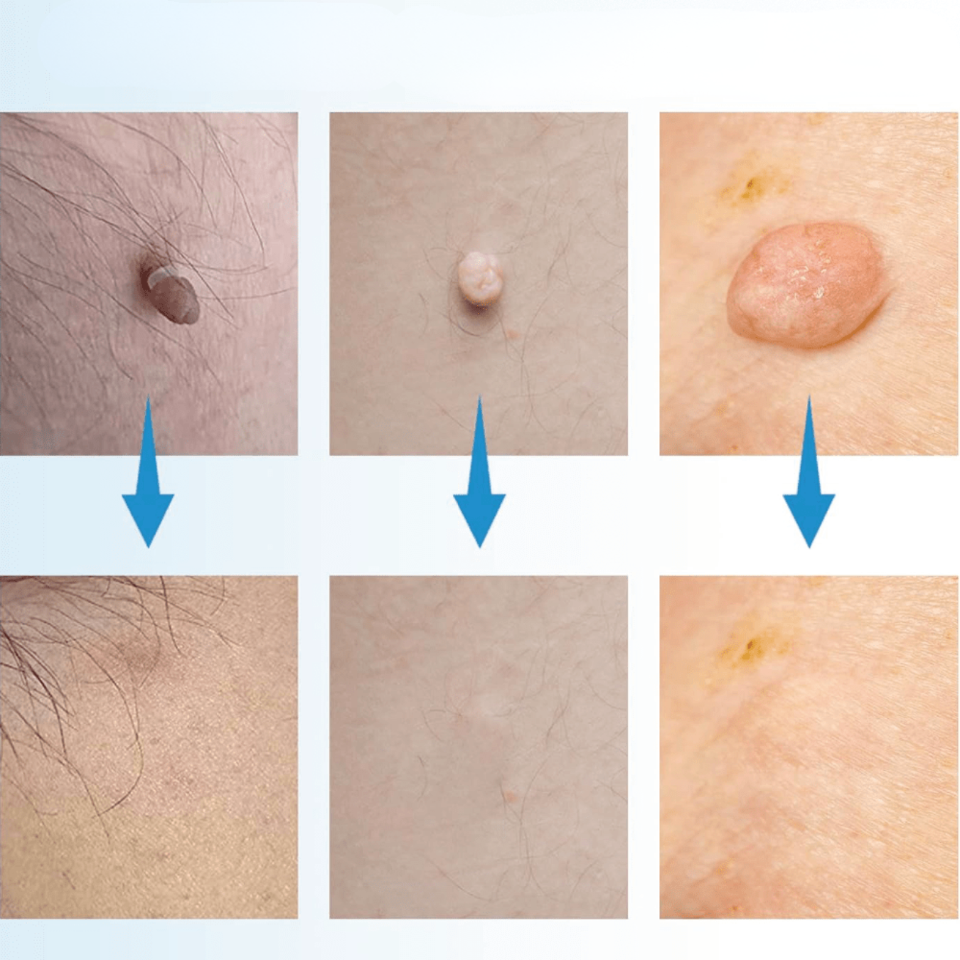 WartAway – Remove warts, completely without chemicals!
