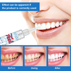 Tooth Whitening Gel Pen