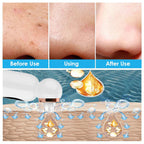 Blackhead Remover and Hydrodermabrasion Device