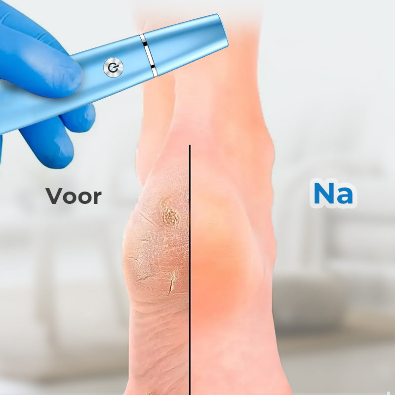 SmoothFoot – Achieve silky smooth feet in just a few minutes