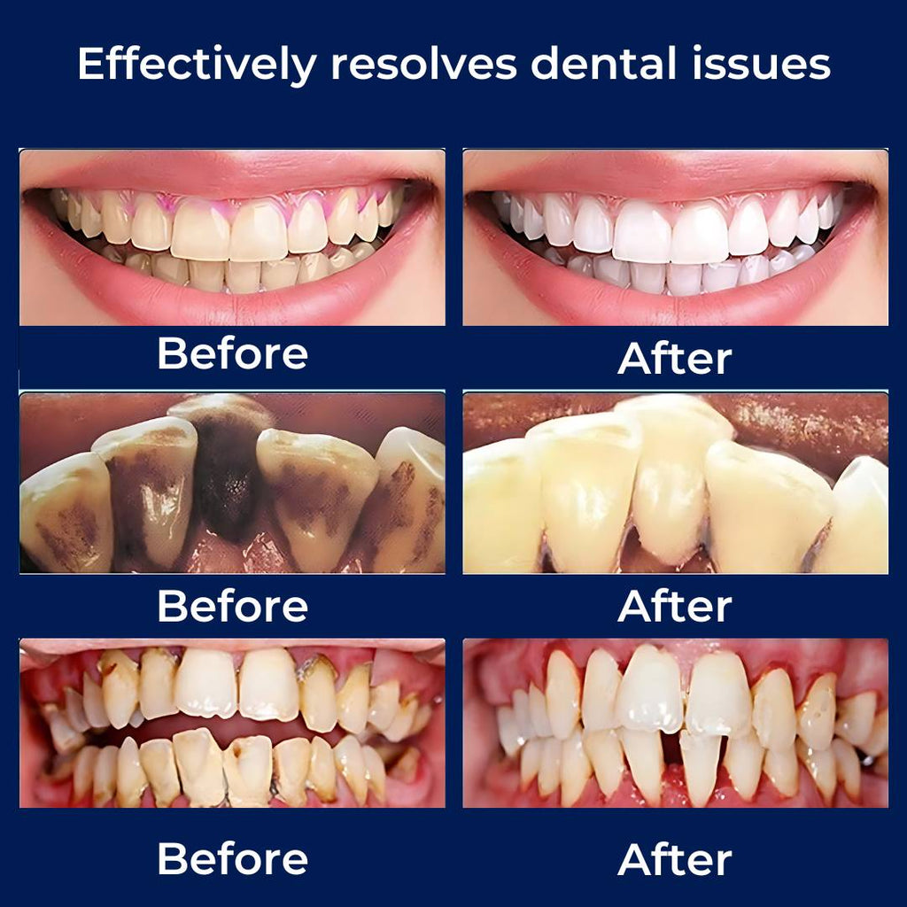PlaqueFree Plaque Remover for teeth | Ultrasonic Teeth Cleaner - Tartar Remover from Home - Deep Teeth Cleaning and Polish