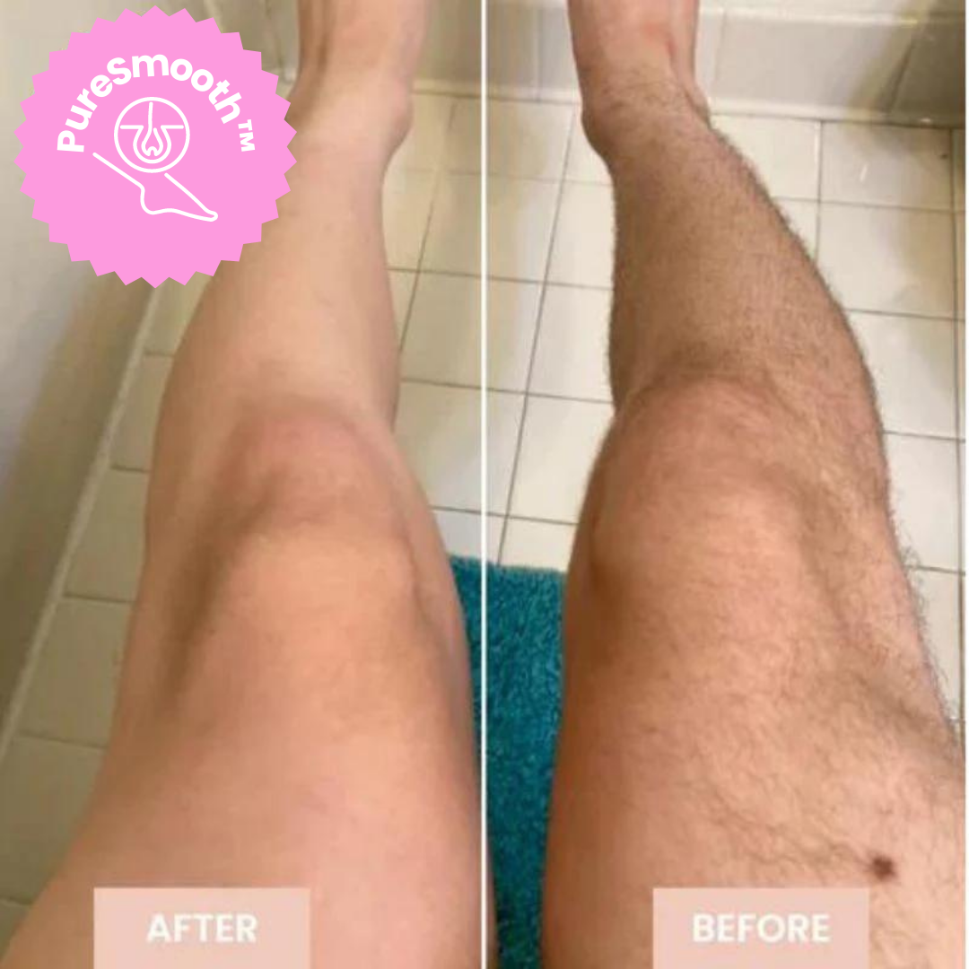 LuxeLaser Flawless Hair Removal in 60 Seconds