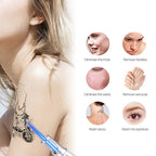 Smart Tattoo Removal Laser Pen - Remove moles, freckles, acne, tattoos