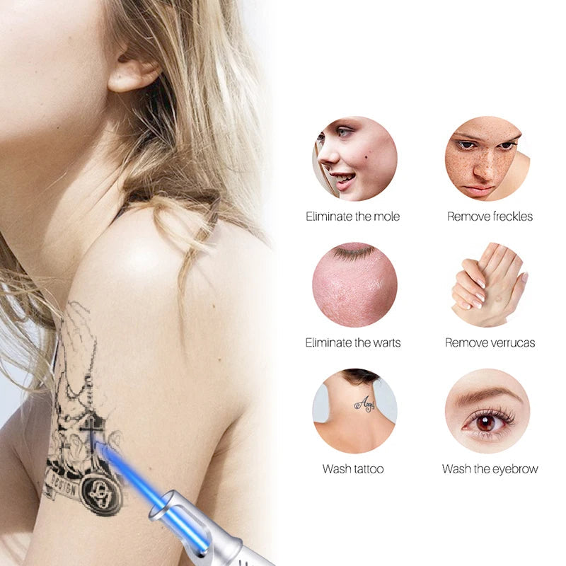 Smart Tattoo Removal Laser Pen - Remove moles, freckles, acne, tattoos