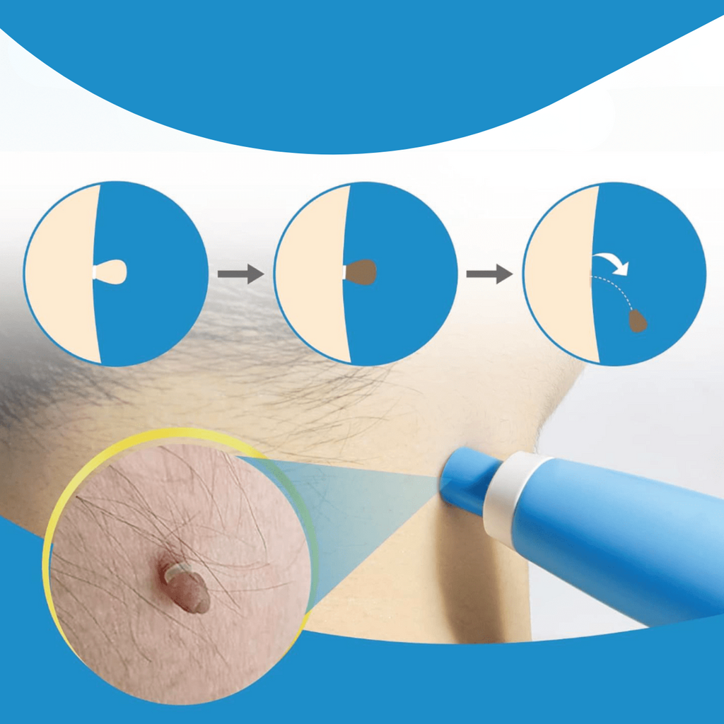 WartAway – Remove warts, completely without chemicals!