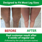Sakerplus Cellulite Massage Roller