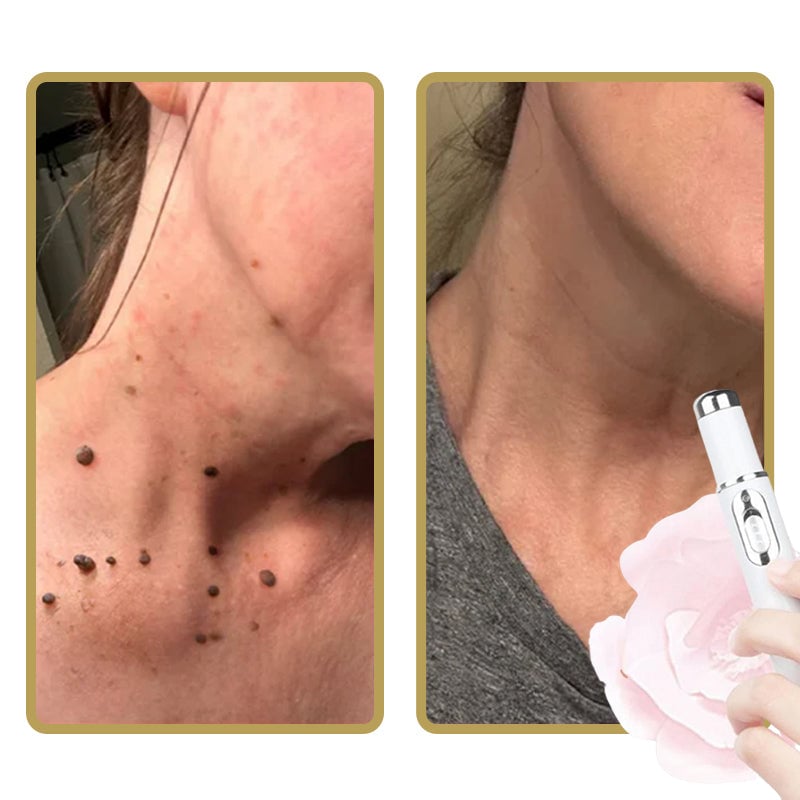 ClearDerm - Quick, painless pimple removal for smooth, clear skin
