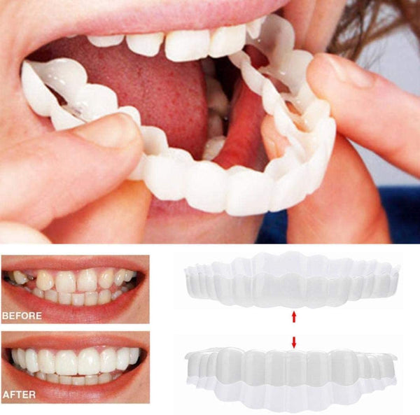 On Smile Veneers (Upper and Lower Jaw included)