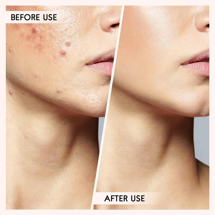 Blackhead and pimple removal set