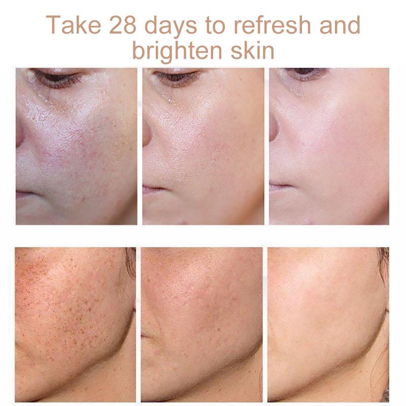 Face Freckles Removal Cream