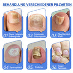 PureNail™ | Nail Fungus Laser Therapy Device - Your Secret Weapon Against Nail Fungus