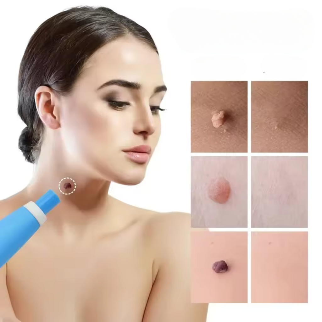 WartAway – Remove warts, completely without chemicals!