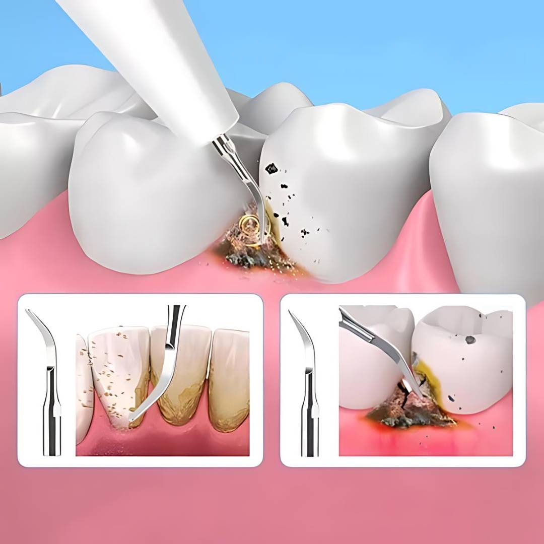 PlaqueFree Plaque Remover for teeth | Ultrasonic Teeth Cleaner - Tartar Remover from Home - Deep Teeth Cleaning and Polish