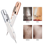 HexoPen️ Wart & Skin Tag Removal Plasma Pen