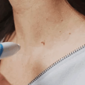 SmoothZap — Pain-free skin freedom for a new sense of confidence in just 10 days