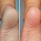 Silicon-Spa-Socks - Intensive care for cracked and tired feet