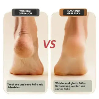 Electric callus remover for smooth feet