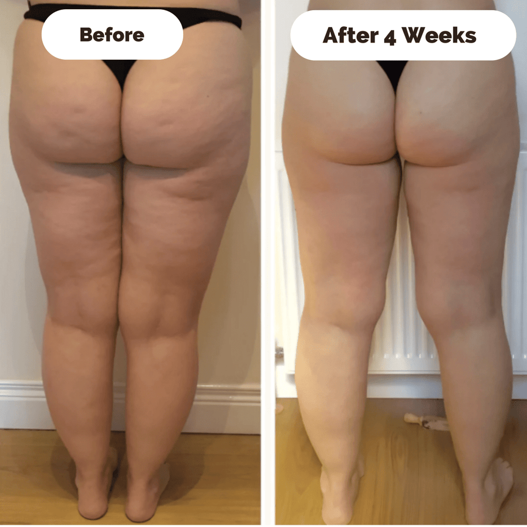 Skin-tightening device against cellulite