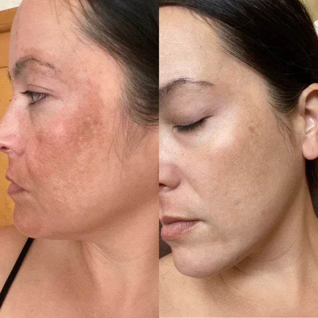 LumiGlow - Pain-Free Treatment: Non-Invasive Therapy