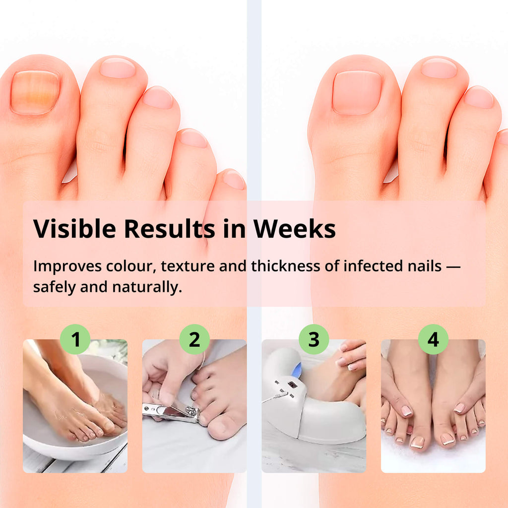 Laser Nail Fungus Removal Device | Advanced Home Treatment with Red & Blue Light for Healthy Nails