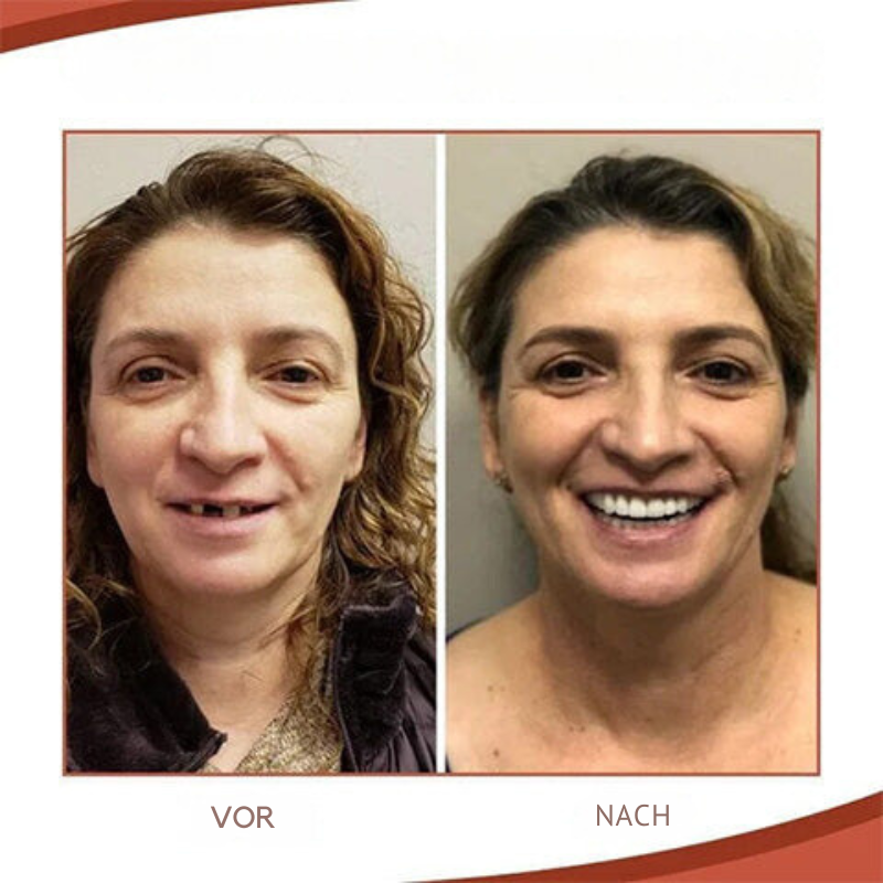 Biocompatible Prosthesis Set for Pain-Free Fit and Natural Smile