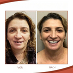Biocompatible Prosthesis Set for Pain-Free Fit and Natural Smile