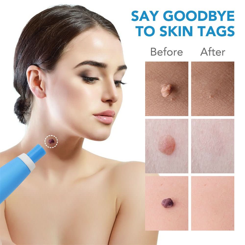 Skin spot remover for warts & skin tags