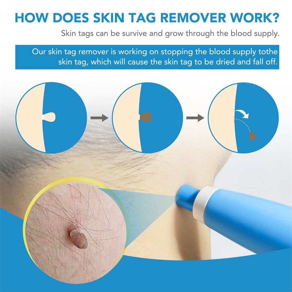 Skin spot remover for warts & skin tags
