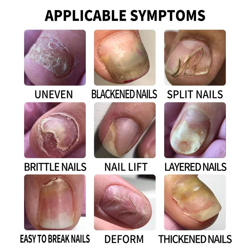 Nail Fungus Defender Serum