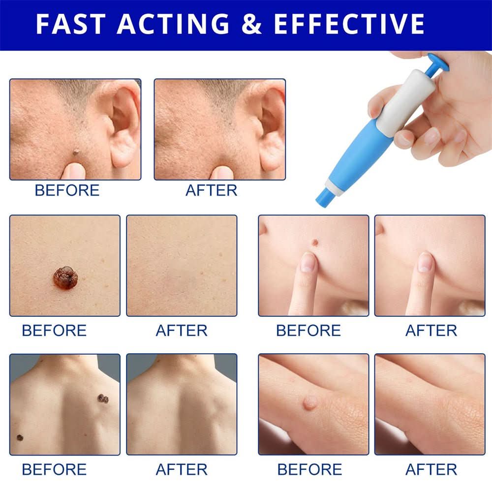 Skin spot remover for warts & skin tags