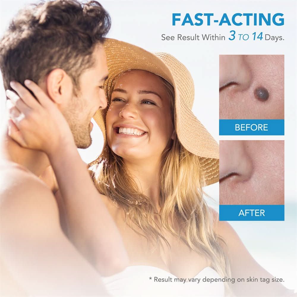 Skin spot remover for warts & skin tags