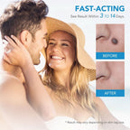 Skin spot remover for warts & skin tags