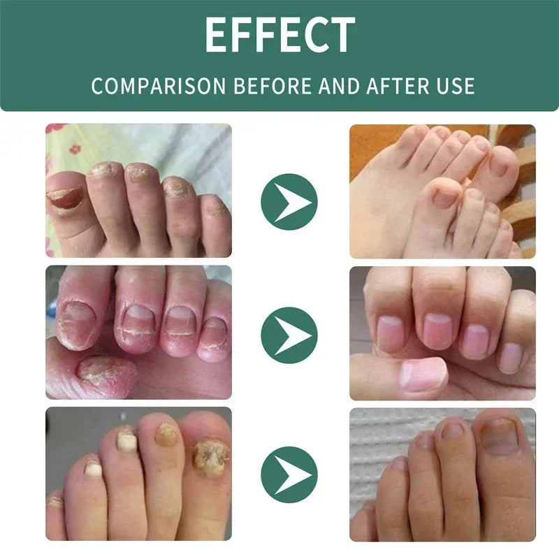 Nail Fungus Defender Serum